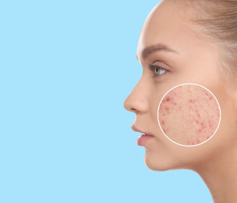 EVITA LAS MANCHAS DE ACNÉ: TIPS PRÁCTICOS PARA DISMINUIR LA HIPERPIGMENTACIÓN